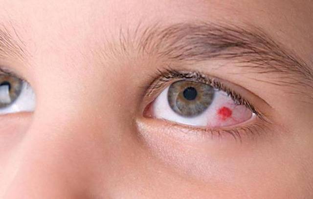 Почему появляется кровоизлияние в глазу у новорожденного?