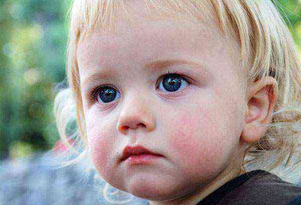 У ваших детей краснели щеки не на пищевой аллерген? - краснеют щеки у ребенка к вечеру - запись пользователя вика вика (id2421275) в сообществе здоровье новорожденных в категории аллергия - babyblog.ru