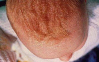 Когда и почему появляются корочки на голове у новорожденного. как убрать желтые корочки на голове, бровях, лице новорожденного