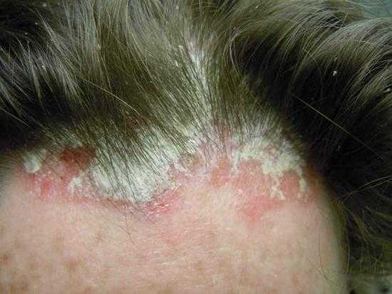 Кожные заболевания: описание и фото. эрозивно-язвенные поражения кожи непонятные болячки на теле