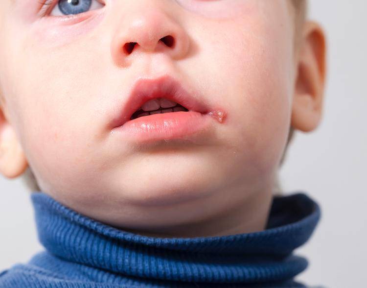 Сыпь у новорожденного на лице и голове: причины, типы, лечение