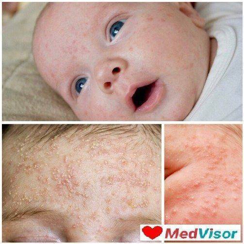 Как выглядит аллергия на коже у ребенка?
