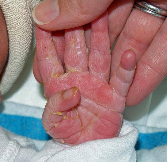 Облазит кожа у ребенка — причина появления шелушения на пальцах рук и ног как предвестник возможного заболевания