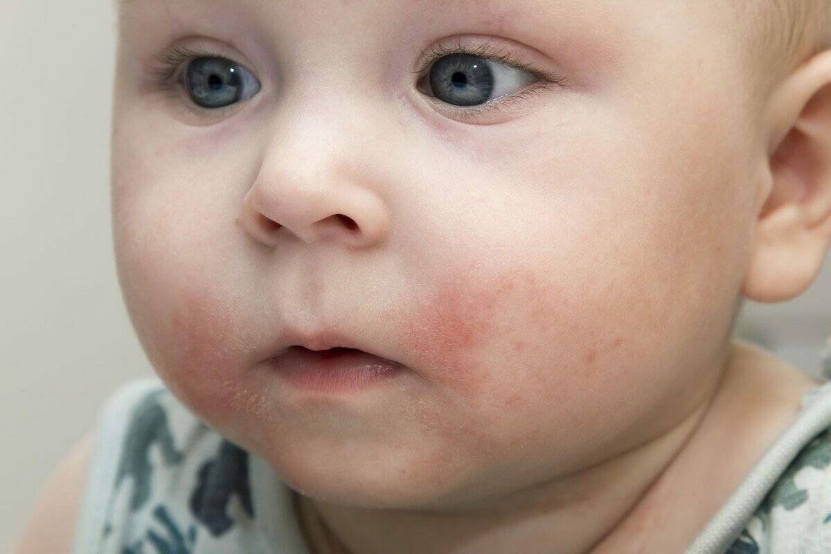 Аллергия на лице, животе и теле у грудничка: лечение. симптомы у грудничка на аллергию пищевую, на пыльцу, стиральный порошок, холод, солнце, контактную