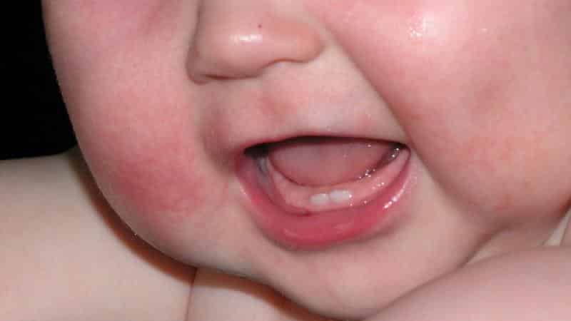 Как лечить сыпь у новорожденных на теле