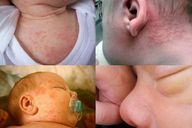 Как отличить потницу от аллергии у грудничка или новорожденного (28 фото): отличия потницы и диатеза на лице, разница и особенности