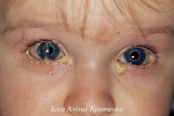 У младенца гноятся глазки: основные причины и способы помощи