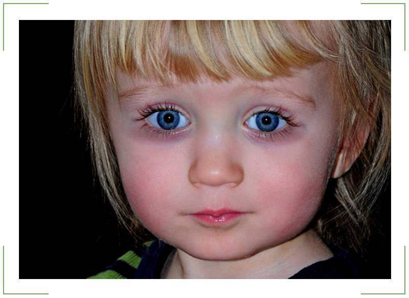 Мешки под глазами у ребенка — причины появления у младенцев