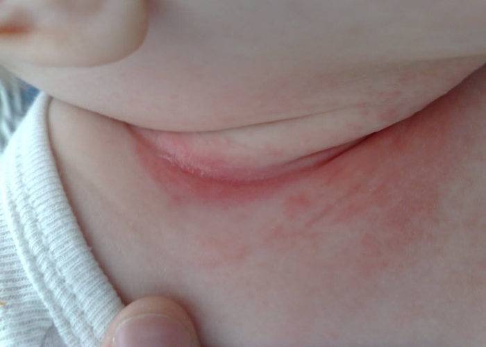 Потница на шее у грудничка и новорожденных (21 фото): как избавиться от потнички, как выглядит
