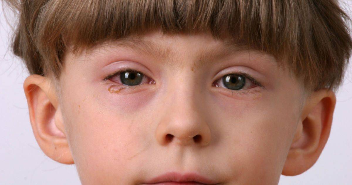 Почему ребенок чешет глаза — что делать