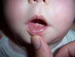 Понос на зубы у ребенка при прорезывании, сколько длится диарея