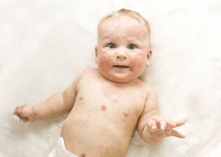 Аллергическая сыпь у ребёнка: как бороться с высыпаниями