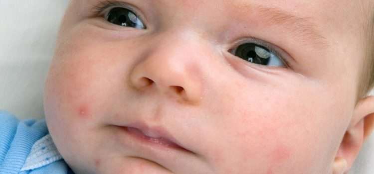 Жировики у новорожденных: причины и лечение