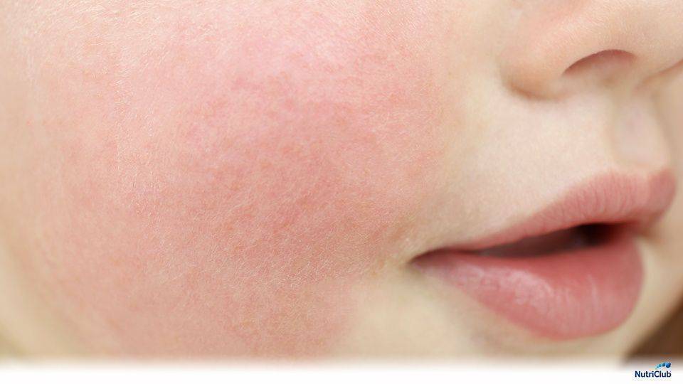 Аллергия у младенцев при грудном вскармливании