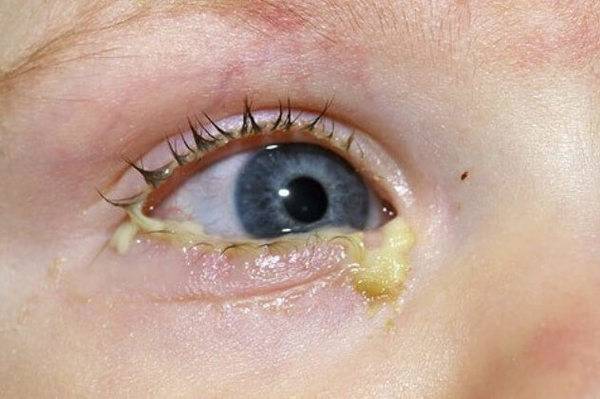 Как появляются мешки под глазами у ребенка и причины их возникновения