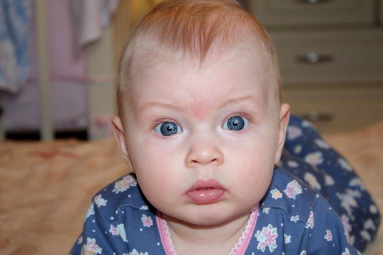 Красные пятна на лице у новорожденного после родов. что делать, если на лице, шее, голове и теле новорожденного появились красные пятна