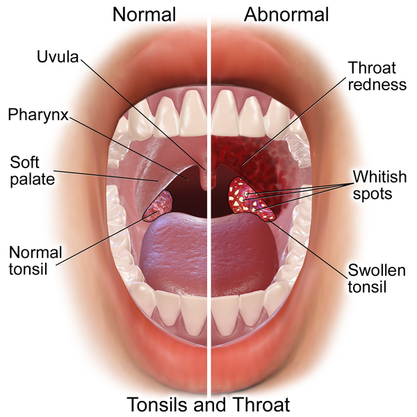 Что такое тонзиллит горла у детей