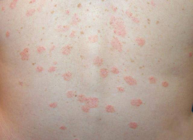 Как отличить аллергию от опрелости у грудничка