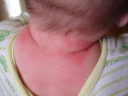 Аллергия на коровье молоко у ребенка