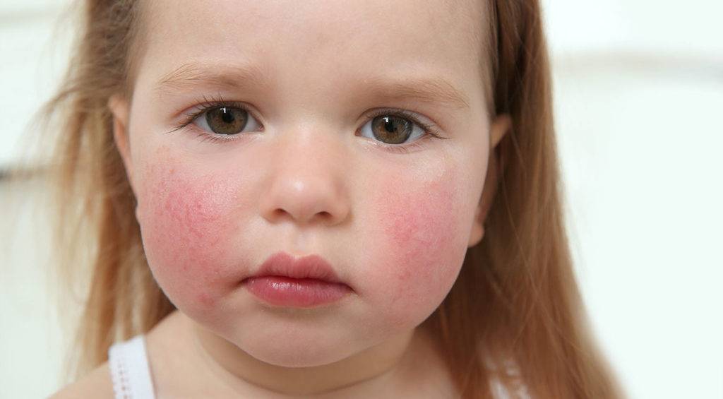 Пищевая аллергия у ребенка (31 фото): симптомы и признаки, как проявляется, лечение и рекомендации