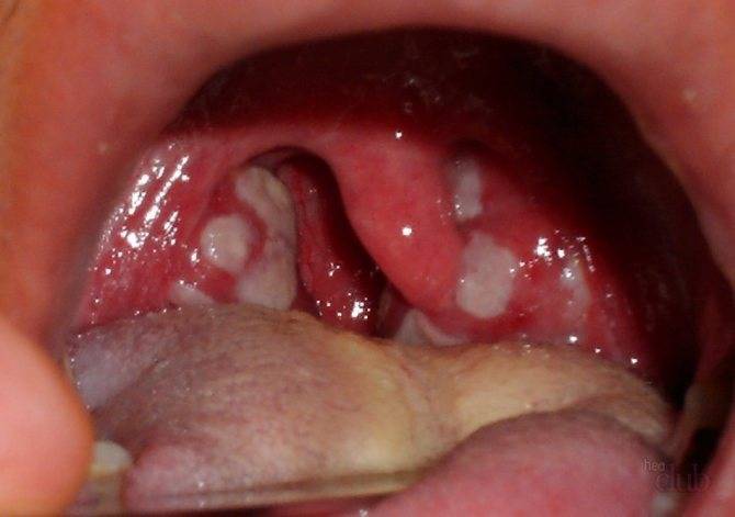 Тонзиллит горла у детей на фото - что это, хронический, симптомы, лечение