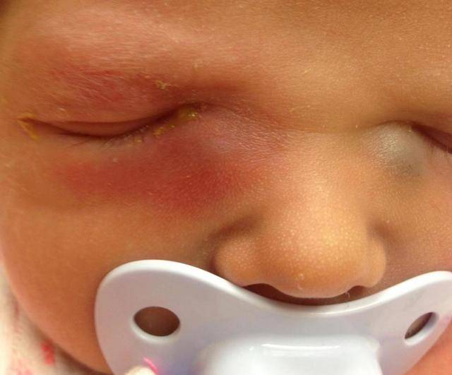 Непроходимость слезного канала (дакриоцистит) - запись пользователя пичуга (pichuga) в сообществе здоровье новорожденных в категории болезни глаз - babyblog.ru