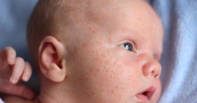 Сыпь аллергическая или трехнедельная сыпь новорожденных? - запись пользователя инночка (id1018833) в сообществе здоровье новорожденных в категории высыпания на коже - babyblog.ru