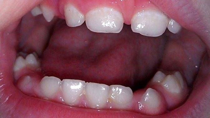 Почему не выпадают молочные зубы