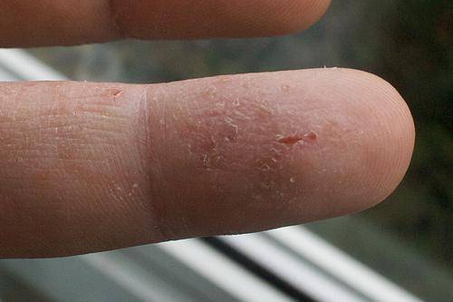 Почему облазит кожа на пальцах взрослых и детей