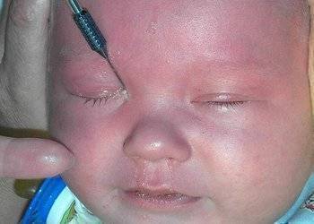 Непроходимость слезного канала у новорожденных. признаки и методы лечения дакриоцистита