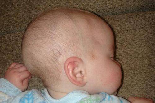 Можно ли править ассиметрию головы? - асимметрия головы у грудничка - запись пользователя светлана (sss237) в сообществе здоровье новорожденных в категории кривошея - babyblog.ru