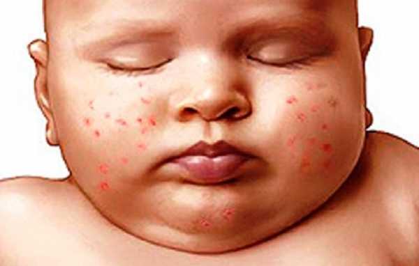 Сыпь на лице у ребенка — что это такое, виды высыпаний