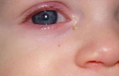 Чем промыть глаза грудному ребенку. чем протирать новорожденным глазки, и как правильно это делать