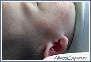Как лечить аллергию на гречку