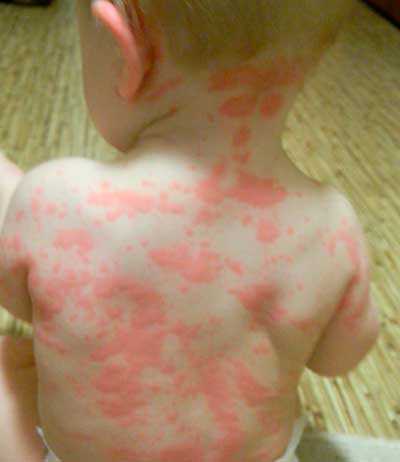 Аллергия на лактозу у грудничка