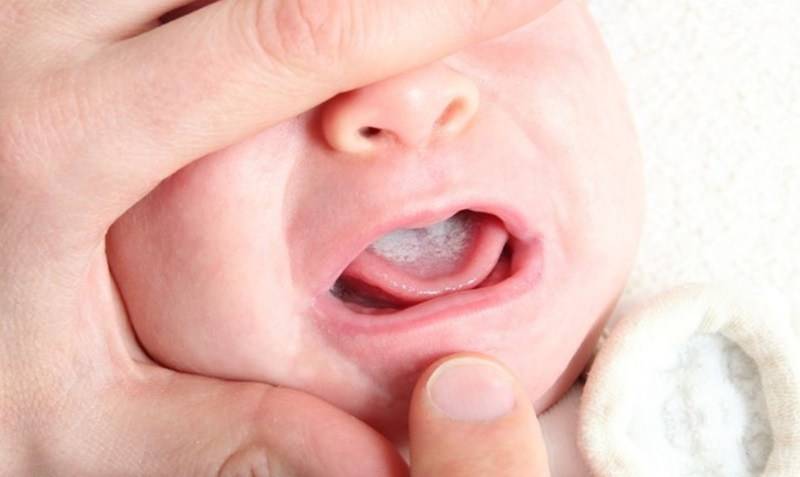 Почему появляются во рту у ребенка язвочки
