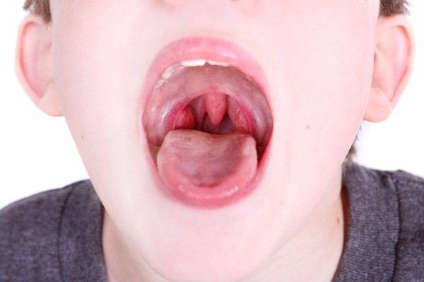 Как выглядит воспаленное и здоровое горло у ребенка
