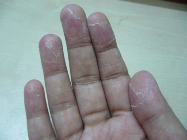 Почему у ребенка облазят пальцы на руках: шелушение кожи на подушечках пальцев