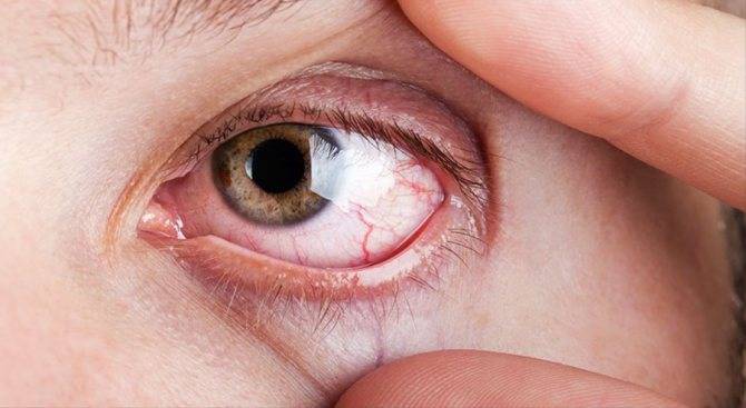Красные глаза у детей: причины, почему покраснел один, у ребёнка краснеют белки, от чего могут быть покраснения по комаровскому