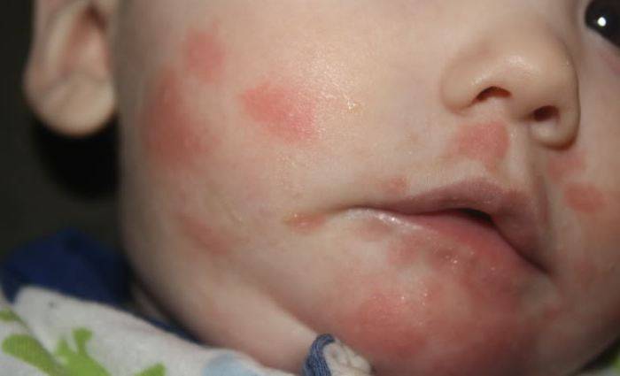 Аллергические реакции у грудных детей - причины и признаки, как выявить аллерген и лечение