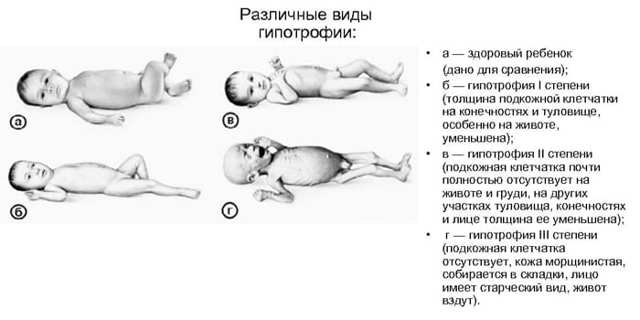 Как избежать докорма смесью, если ребенок плохо набирает вес? - запись пользователя евгения (id1943209) в сообществе грудное вскармливание в категории переход с св на гв, как сохранить гв при св - babyblog.ru