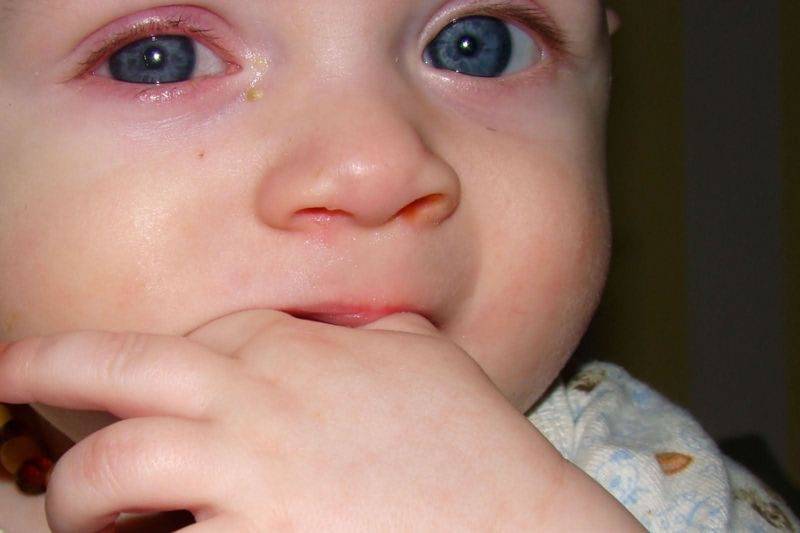 Комаровский - массаж слезного канала у новорожденных: массаж глаза при непроходимости слезного канала