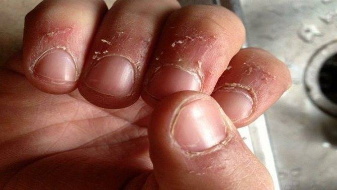 Трещины на пальцах рук. причины и лечение. 4 популярных метода народного врачевания