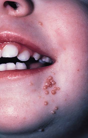 Сыпь в паху у ребенка симптомы