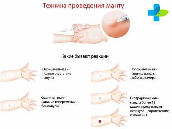 Манту....объясните запуталась... - нет папулы после манту - запись пользователя елена (lenusik2304) в сообществе детские болезни от года до трех в категории прививки - babyblog.ru