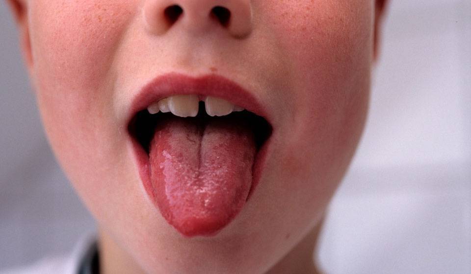 Стоматит на языке у взрослых: причины, симптомы, виды, как и чем лечить