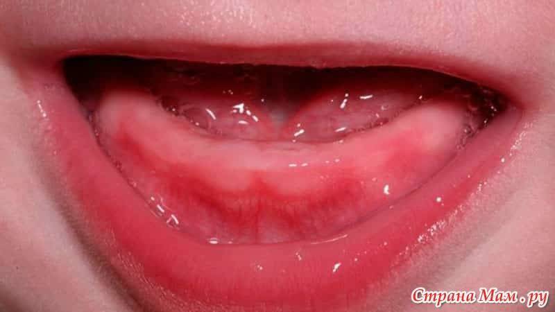 С чем связана температура при прорезывании зубов у детей?