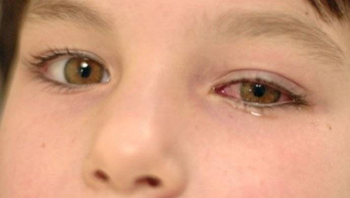 Почему гноятся глаза у ребенка, что делать, как удалить гной