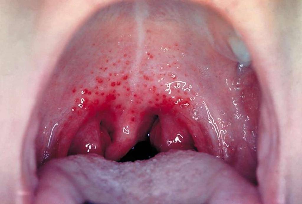Красное горло у ребенка чем лечить (46 фото): болит, температура, точки, 2 года