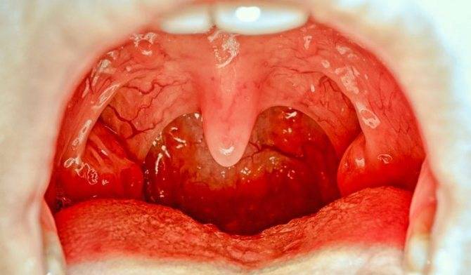 Красное горло у грудничка — как определить и лечение